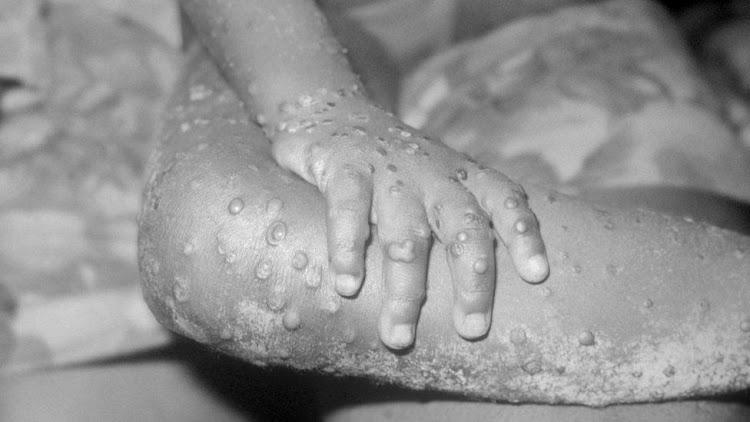 WHO Declares Mpox Outbreak a Public Health Emergency