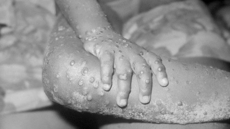 WHO Declares Mpox Outbreak a Public Health Emergency