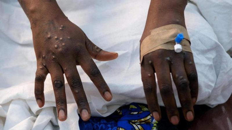 File image of a patient with the Marburg virus.