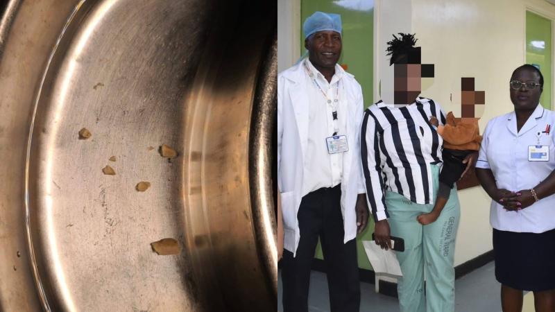 File image of groundnuts extracted from the patient's lungs and KNH medical personnel